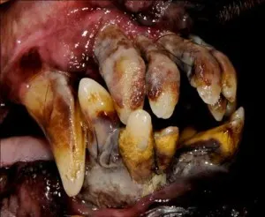 periodontaldisease_clip_image002